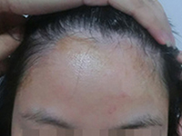 女性患白癜风为什么比男性高